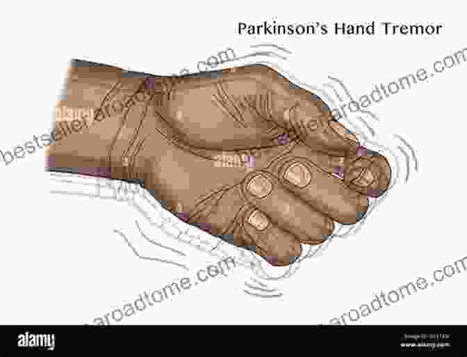 A Vintage Illustration Depicting A Person With A Hand Tremor. Clinical Lessons On Nervous Diseases (1897)