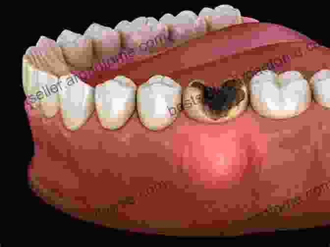 Informed Health Decisions Surviving The Abscess Tooth Battle: What To Do Before Making It To The Doctor