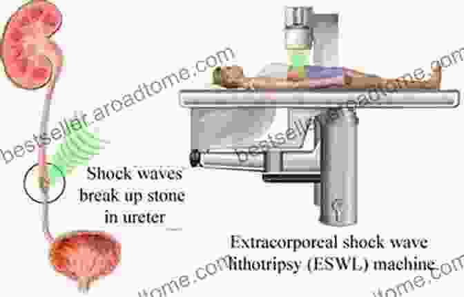 Lithotripsy Uses Focused Shock Waves To Break Down Kidney Stones, Visible As Small Fragments Sonic Thunder: A Discussion Of Natural And Artificial Shock Waves (Iop Concise Physics)