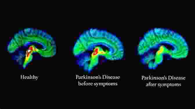 Parkinson's Disease: My Brain This Time Parkinson S Disease: My Brain This Time